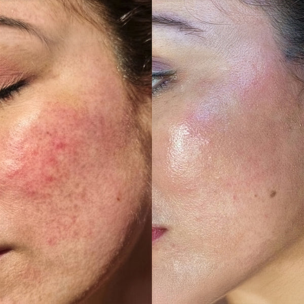 Rosacea, Redness & Inflammation