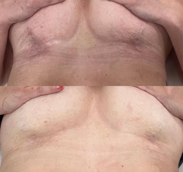 Scar Reduction & Striae