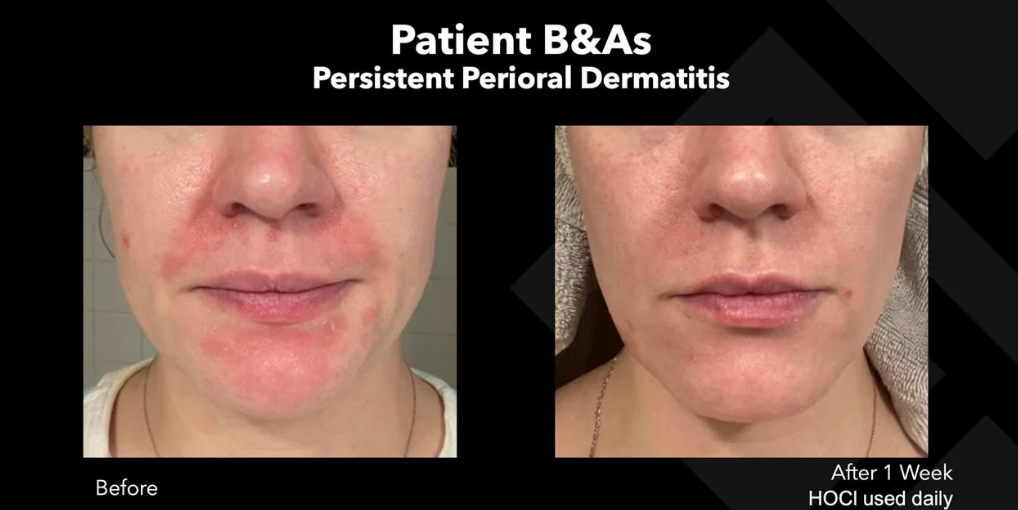 Hale Derma Spray